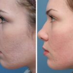 سابسیژن کلاسیک برای جای جوش