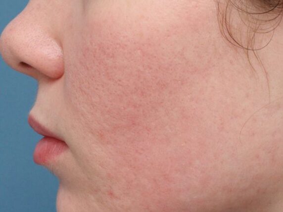 06_Subcision_for_Acne_Scars-1