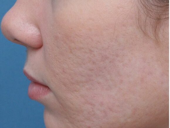 06_Subcision_for_Acne_Scars-1