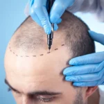 انواع روش‌ها کاشت مو و مراقبت‌های بعد از آن از زبان دکتر مهدی صادق نژاد